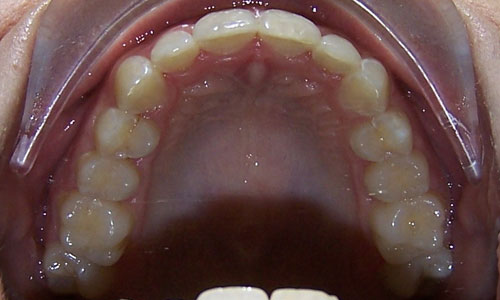 Patient smile after orthodontic treatment (case 12)