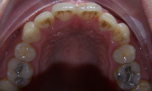 Patient smile before orthodontic treatment (case 19)