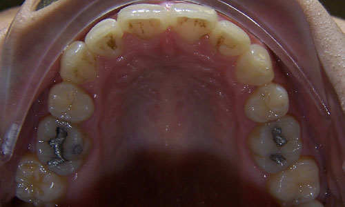 Patient smile after orthodontic treatment (case 19)