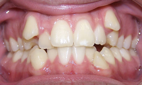 Patient smile before orthodontic treatment (case 9)