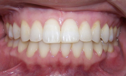 Patient smile after orthodontic treatment (case 9)