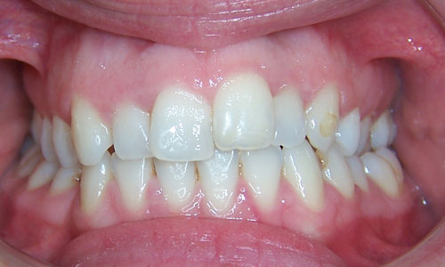 Patient smile before orthodontic treatment (case 5)