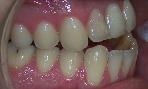 Patient smile before orthodontic treatment (case 27)