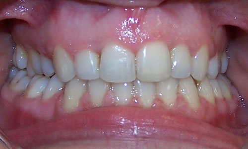 Patient smile after orthodontic treatment (case 5)