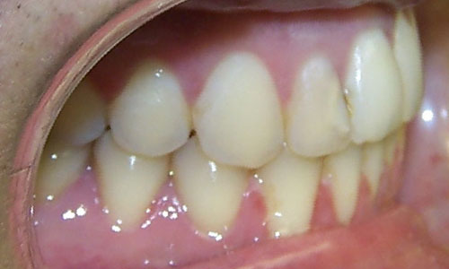 Patient smile after orthodontic treatment (case 27)