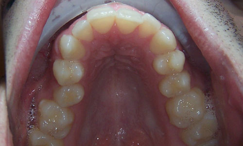 Patient smile before orthodontic treatment (case 17)