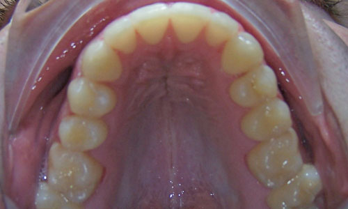 Patient smile after orthodontic treatment (case 17)