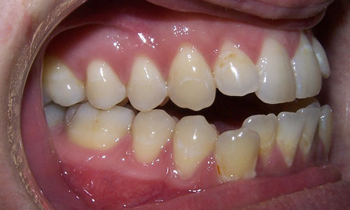 Patient smile before orthodontic treatment (case 28)