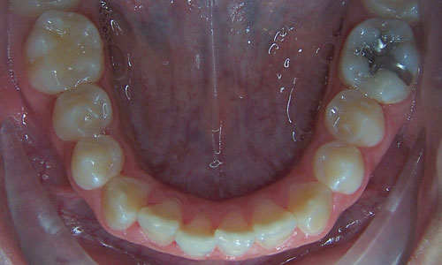 Patient smile before orthodontic treatment (case 13)