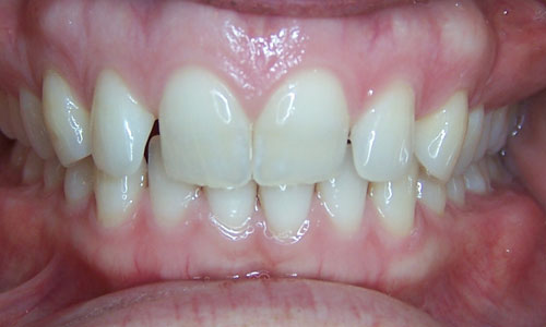 Patient smile before orthodontic treatment (case 4)