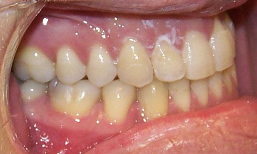 Patient smile after orthodontic treatment (case 28)