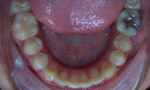 Patient smile after orthodontic treatment (case 13)