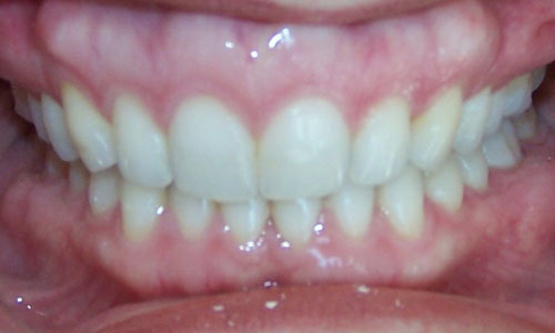Patient smile after orthodontic treatment (case 4)