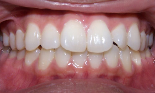 Patient smile before orthodontic treatment (case 18)