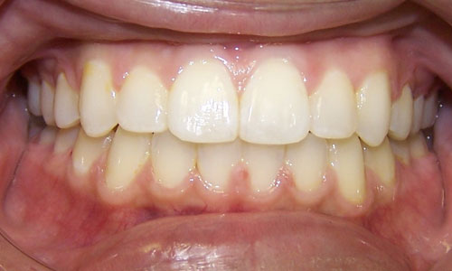 Patient smile after orthodontic treatment (case 18)