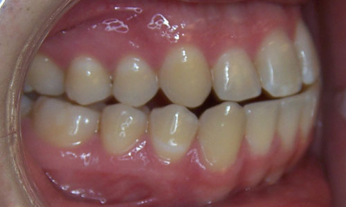 Patient smile before orthodontic treatment (case 29)