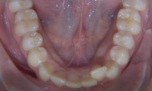 Patient smile before orthodontic treatment (case 20)