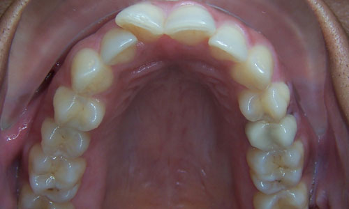 Patient smile before orthodontic treatment (case 7)