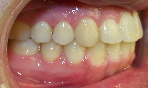 Patient smile after orthodontic treatment (case 29)