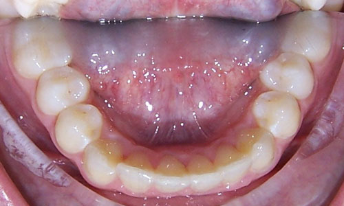 Patient smile after orthodontic treatment (case 20)