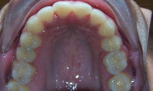 Patient smile after orthodontic treatment (case 7)
