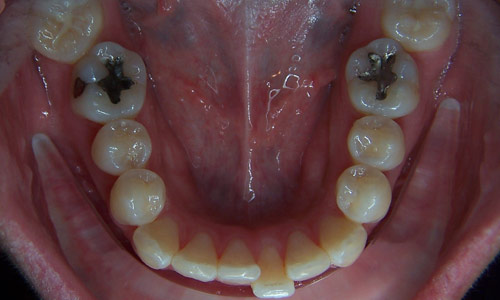 Patient smile before orthodontic treatment (case 6)