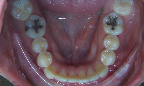 Patient smile after orthodontic treatment (case 6)