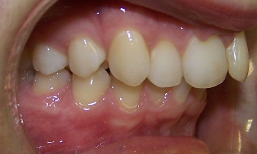 Patient smile before orthodontic treatment (case 19)