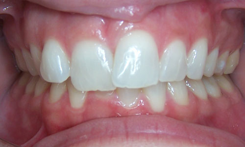 Patient smile before orthodontic treatment (case 14)