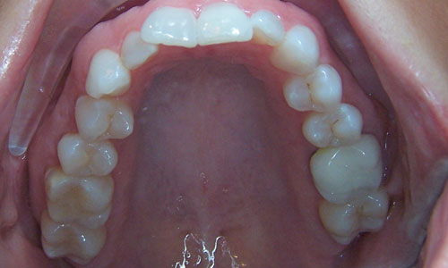 Patient smile before orthodontic treatment (case 2)