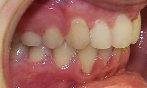 Patient smile after orthodontic treatment (case 19)