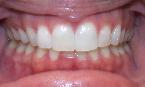 Patient smile after orthodontic treatment (case 14)