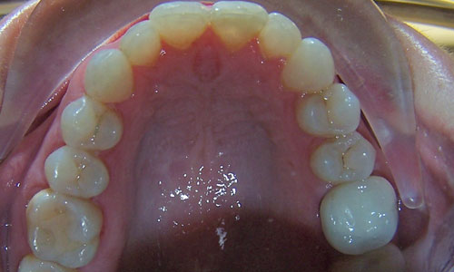 Patient smile after orthodontic treatment (case 2)
