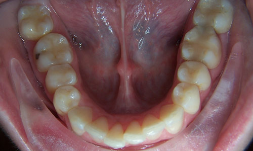 Patient smile before orthodontic treatment (case 21)