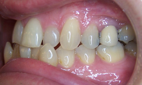 Patient smile before orthodontic treatment (case 30)