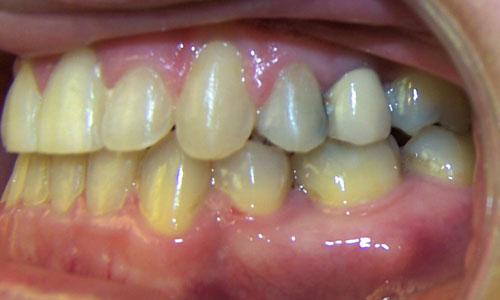 Patient smile after orthodontic treatment (case 30)