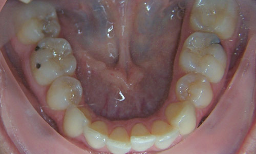 Patient smile before orthodontic treatment (case 7)