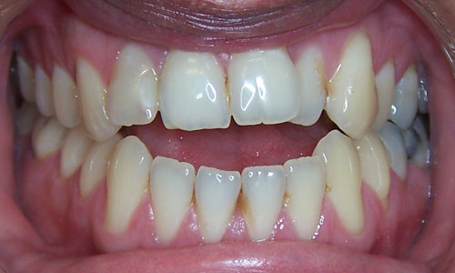 Patient smile before orthodontic treatment (case 2)