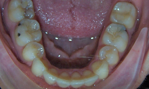 Patient smile after orthodontic treatment (case 7)
