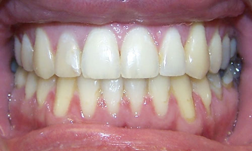 Patient smile after orthodontic treatment (case 2)