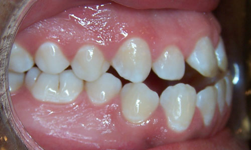 Patient smile before orthodontic treatment (case 31)
