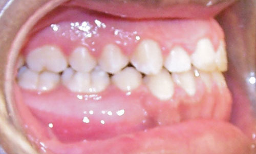 Patient smile after orthodontic treatment (case 31)