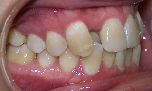 Patient smile before orthodontic treatment (case 10)