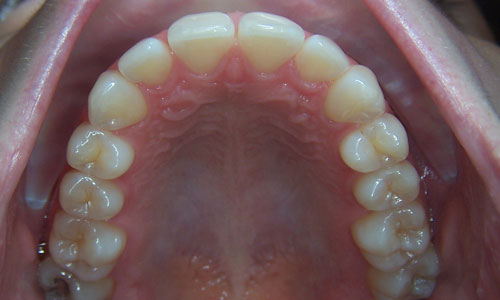 Patient smile before orthodontic treatment (case 15)