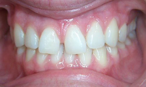 Patient smile before orthodontic treatment (case 5)