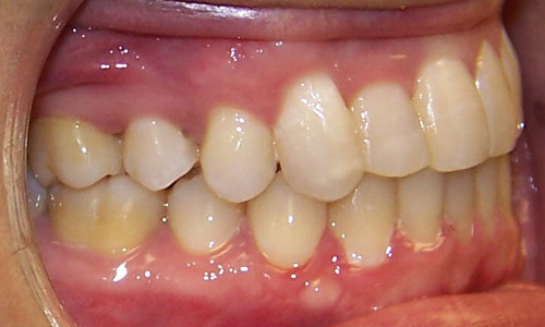 Patient smile after orthodontic treatment (case 10)