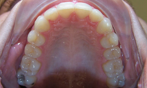 Patient smile after orthodontic treatment (case 15)