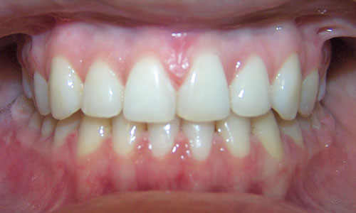 Patient smile after orthodontic treatment (case 5)