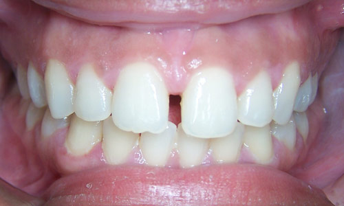 Patient smile before orthodontic treatment (case 22)