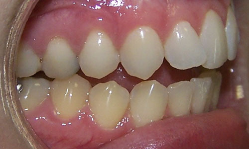 Patient smile before orthodontic treatment (case 21)